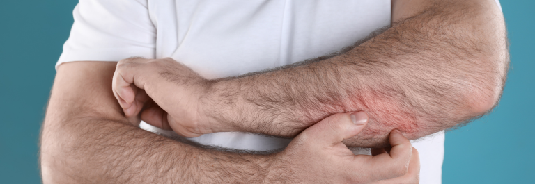 Close up image of man scratching itchy forearms rash