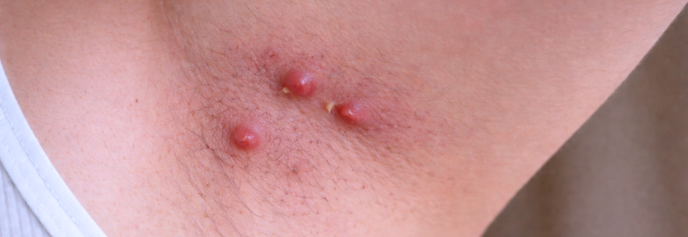Hidradenitis Suppurativa on a person's armpit