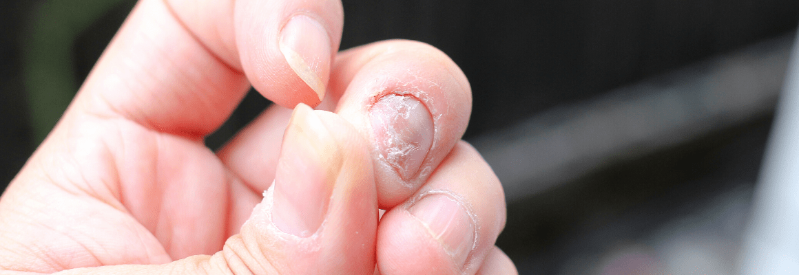 What’s the Difference: Nail Psoriasis vs. Fungus