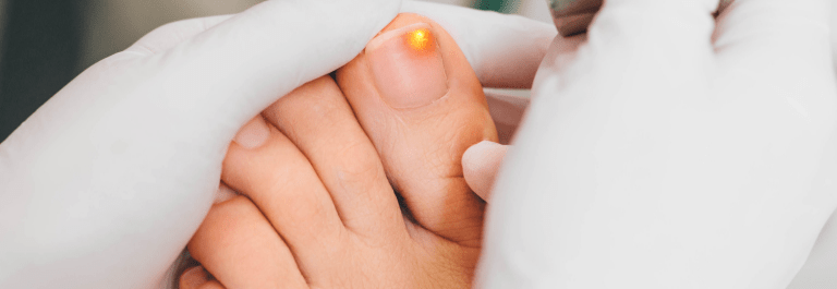 The Best Natural Remedies for Toenail Fungus