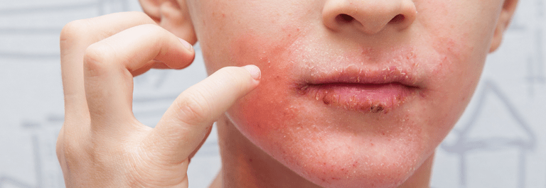 How to Treat Perioral Dermatitis at Home