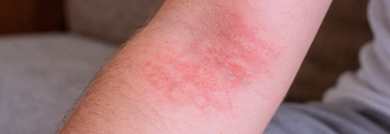 5 Remedies For Healing Weeping Dermatitis Naturally