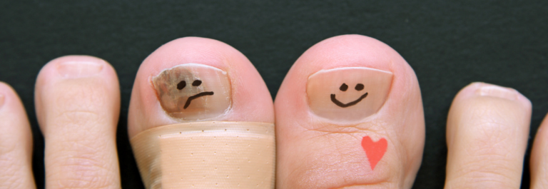 nail psoriasis: two big toe nails, one with a frown and the other with a happy face 