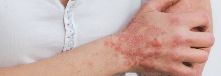 person with psoriasis on wrist and hand scratching their arm